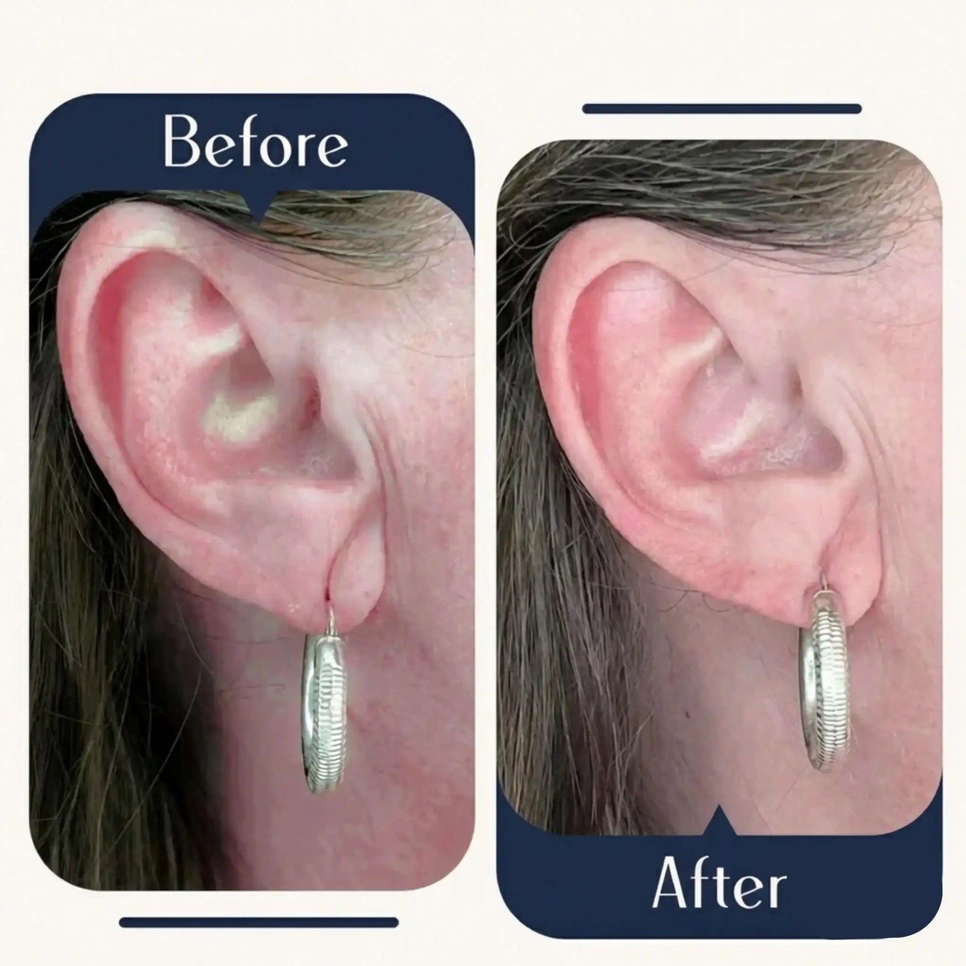 Premium Earlobe Support Patches (100 PCS) - Diaarp